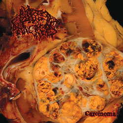 Blasted Pancreas - Carcinoma - CD